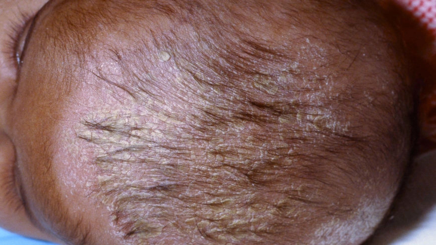 Arp (Seboroisk Dermatitis)